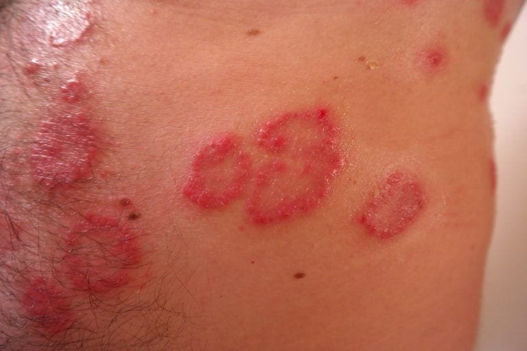Psoriasis: cómo evitarla y tratarla