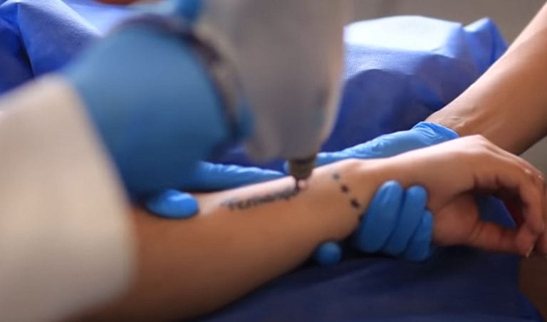 Todo lo que tienes que saber sobre las máquinas láser para quitar tatuajes