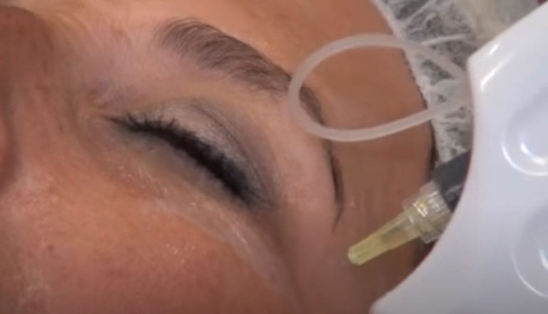 ¿Qué es la mesoterapia facial y para qué sirve?
