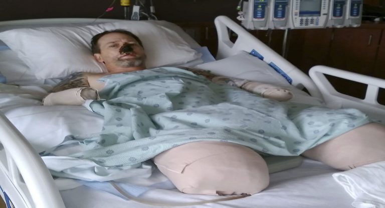 Hombre pierde varias partes del cuerpo por lamidas de su perro